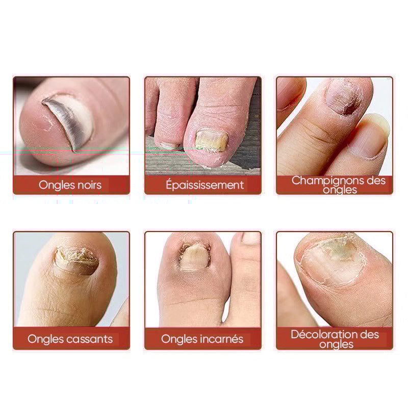 Plaques fongiques sur les ongles