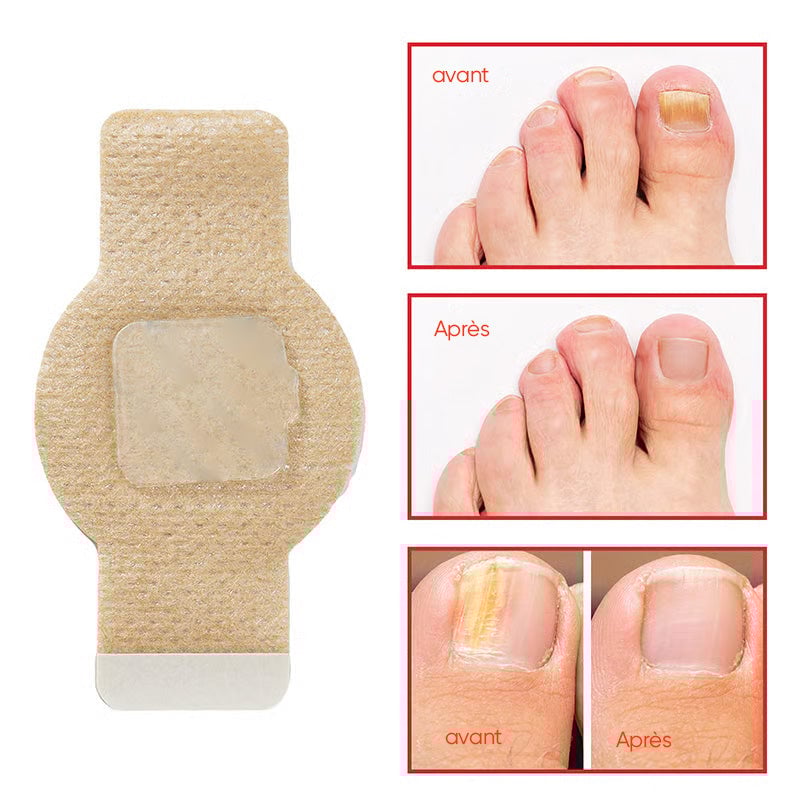 Plaques fongiques sur les ongles